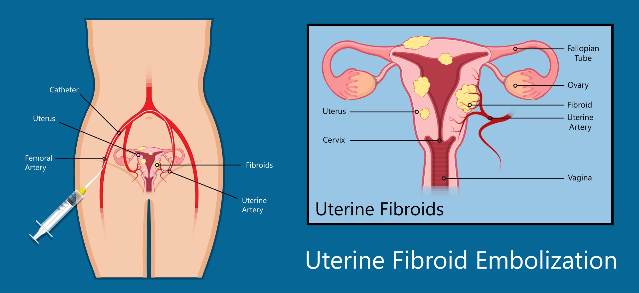 shutterstock 1194708520 1 ai 1 scaled showing the concept of Uterine Fibroid Embolization